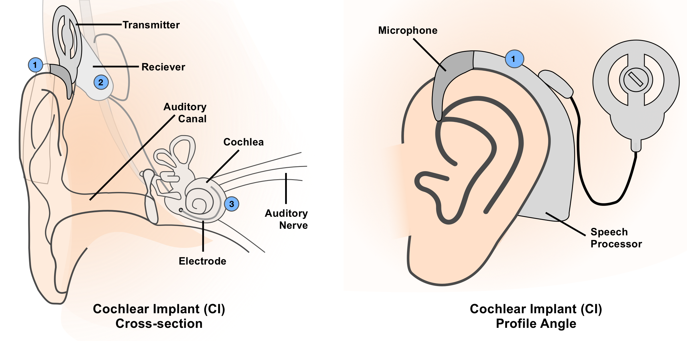 Diagram of Cochlear Implant